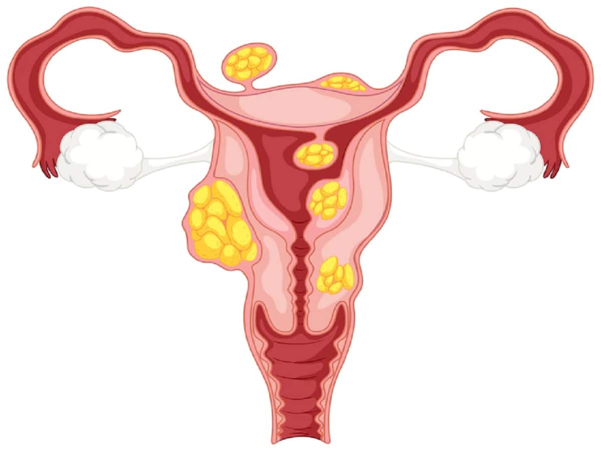 Uterine Fibroids Can Cause Infertility: Know How